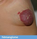 hemangiome hemangiome