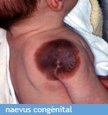 naevus naevus